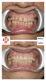 Full-Mouth-Rehabilitation-150x265.png