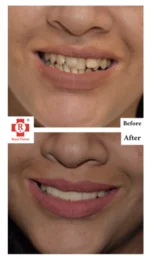 smile-makeover-150x260.png